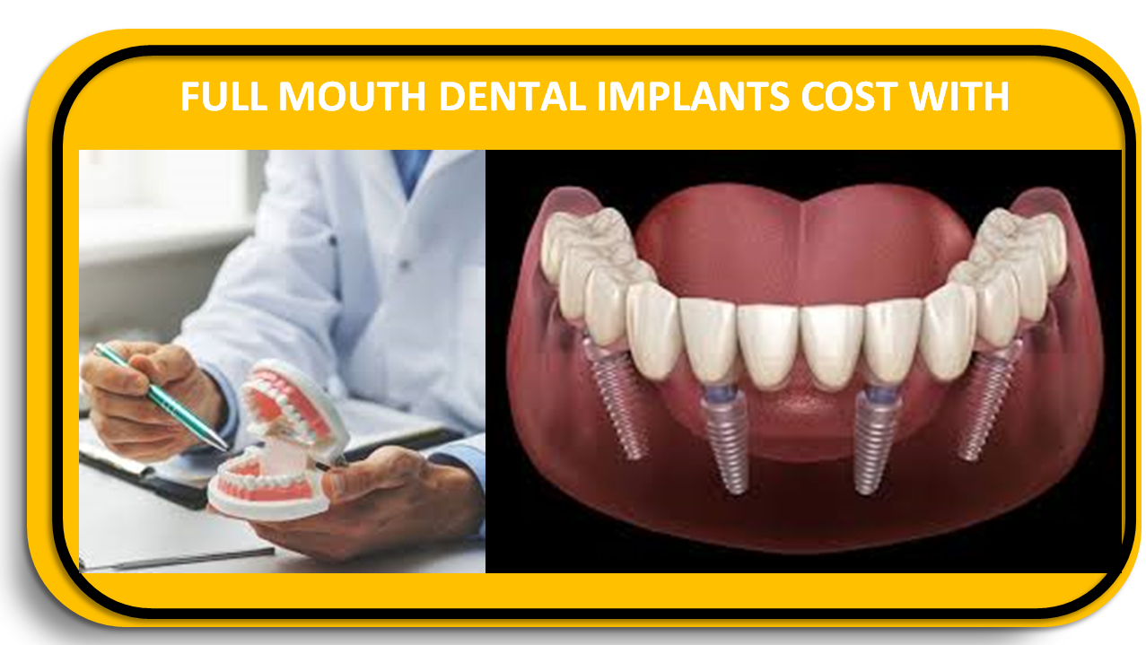 Full Mouth Dental Implants Cost With Insurance