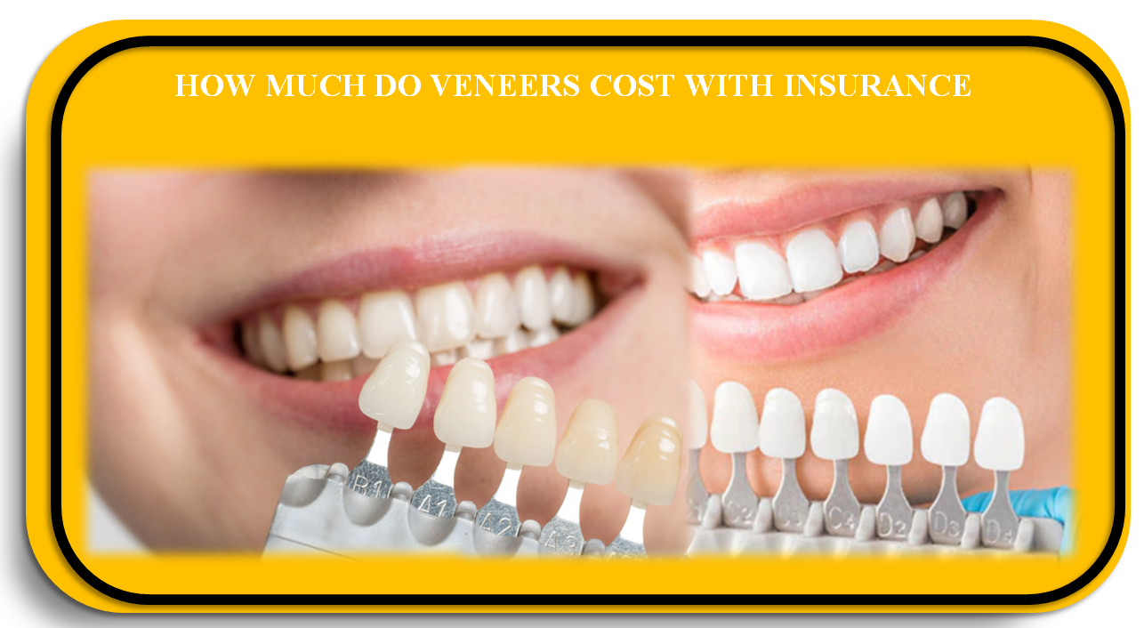How much do Veneers cost with Insurance