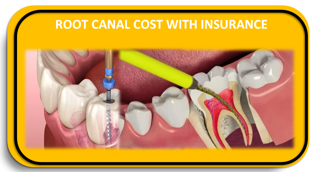 Root Canal cost with Insurance